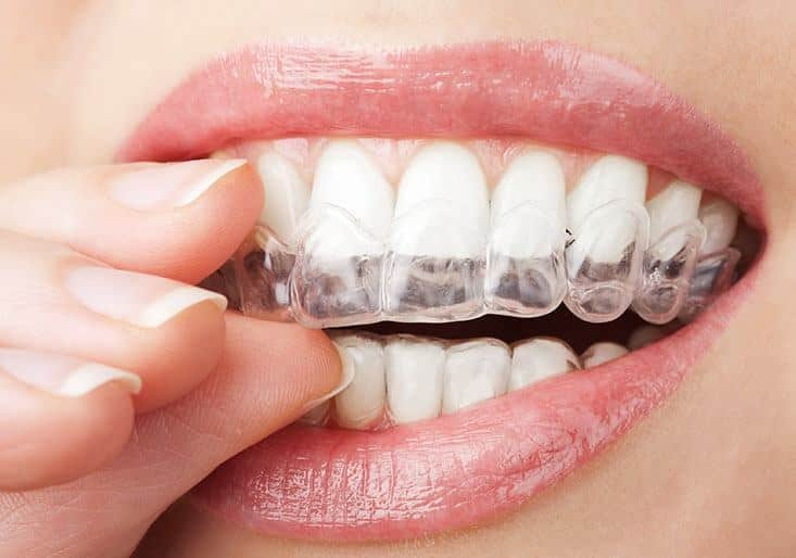 Simple Hacks On Taking Care Of Your Veneers